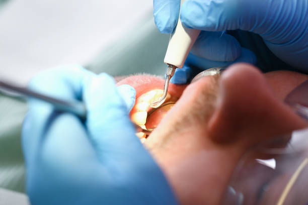 Best Emergency Treatment for Oral Infections in Sachse, TX